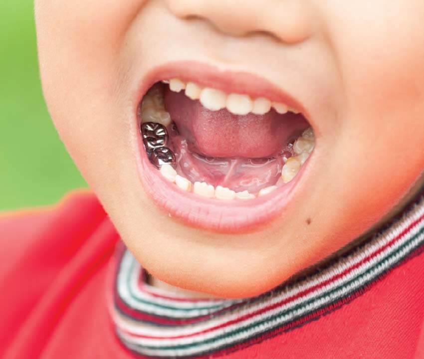 Does Kids Dental Crown Really Save A Baby Tooth