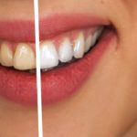 LED Teeth Whitening Safe and Effective for Your Teeth